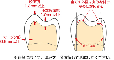 CAD/CAM冠